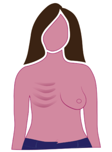 Breast Forms, Breakout Bras